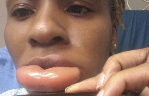 Une importante réaction allergique à cause d'un rouge à lèvres